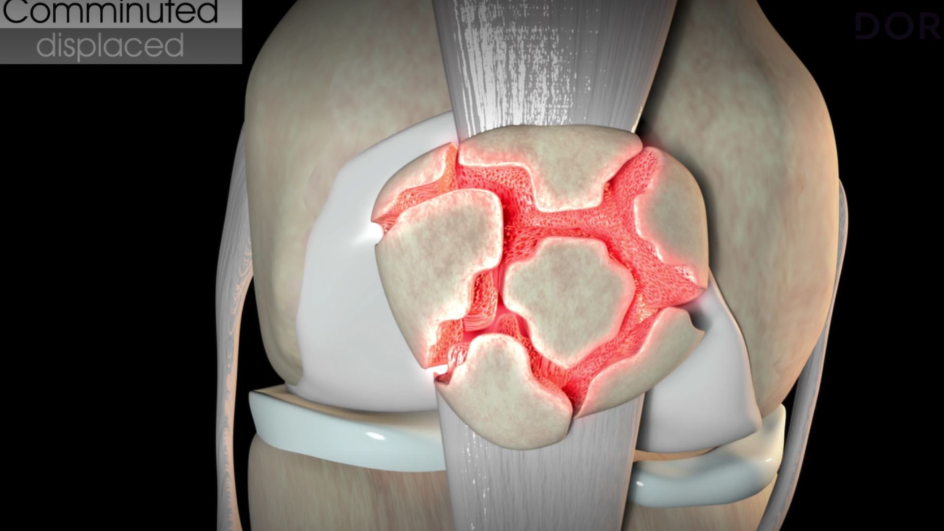 La Osteoporosis La Enfermedad Silenciosa Doryos Doryos