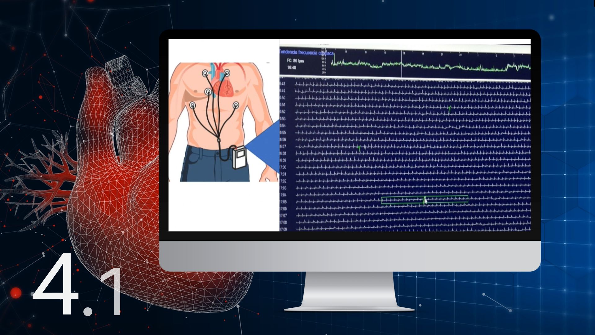 4 1 Interpretación del electrocardiograma en el Holter Doryos