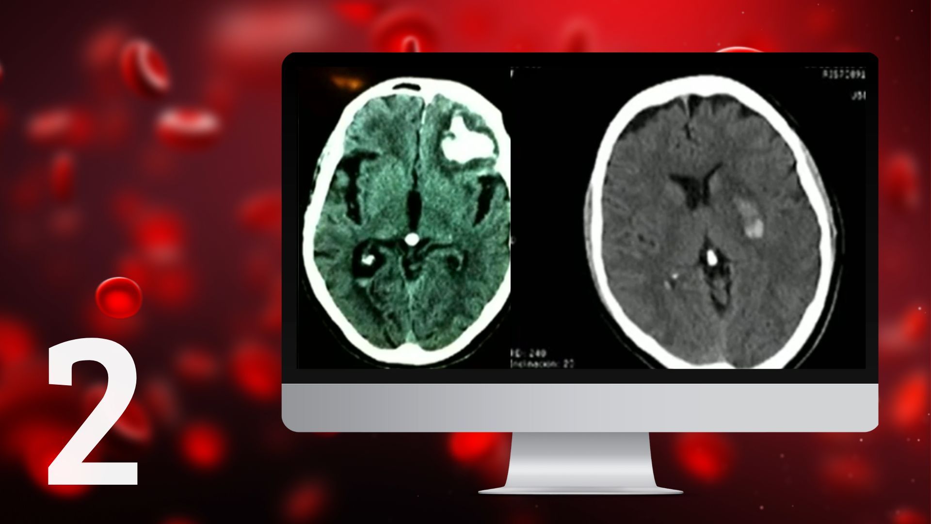 Anticoagulación oral tras sufrir un infarto cerebral o una hemorragia ...